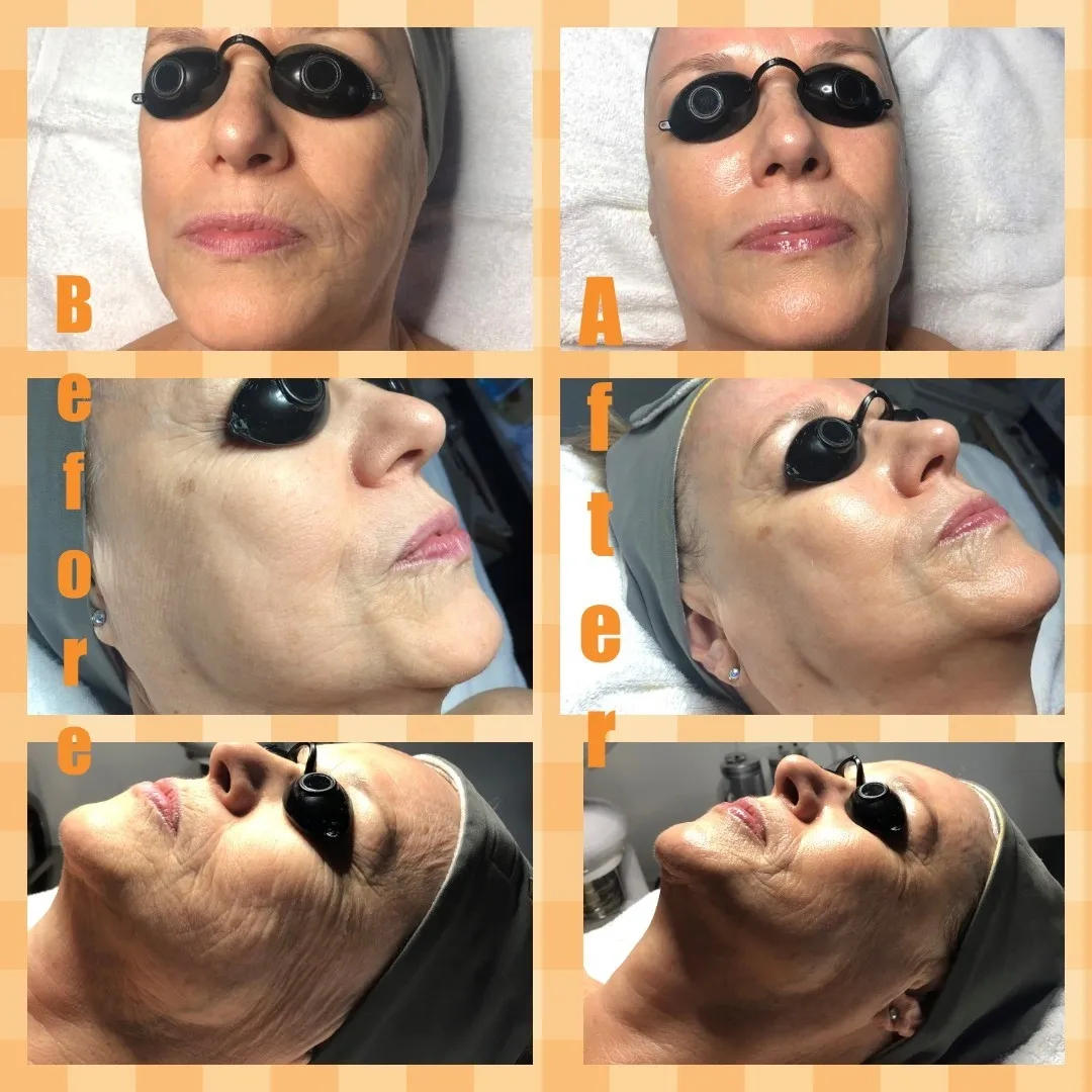 Before and after results from one ReZENerate NanoFacial